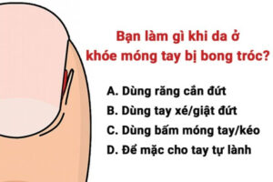 Hành Động Khi Da Khóe Móng Tay Bong Tróc Tiết Lộ Về Bạn